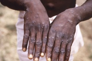 Les mains d'une personne infectée par le virus du mpox en RDC (archives). KEYSTONE/AP CDC